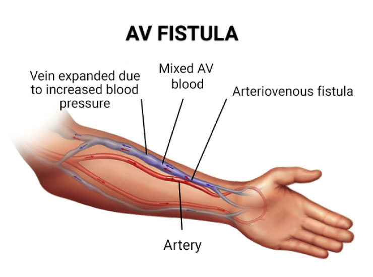 Dialysis Fistula Surgery